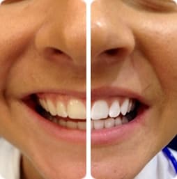 PureSmile Treatment Results Example