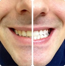 PureSmile Treatment Results Example