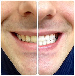 hi smile teeth straightening