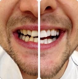 PureSmile Treatment Results Example