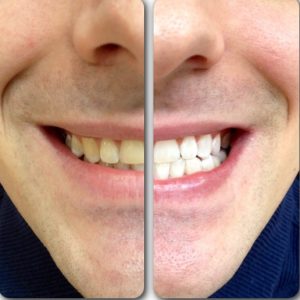 Before And After Teeth Whitening (2)
