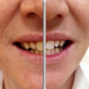 Before And After Teeth Whitening (3)