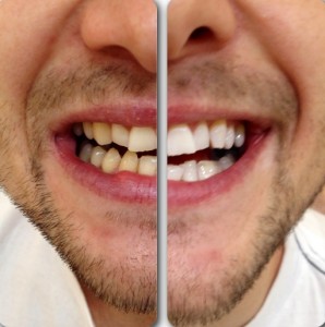 Before And After Teeth Whitening (4)
