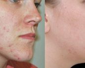 Acne Scars treatment