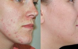 Acne Scars treatment