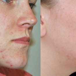 Acne Scars treatment