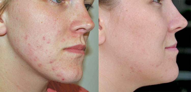 Best Acne Scar Treatments or Home Remedies | PureSmile 