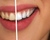 Teeth Whitening - Before and After Treatment