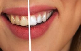 Teeth Whitening - Before and After Treatment
