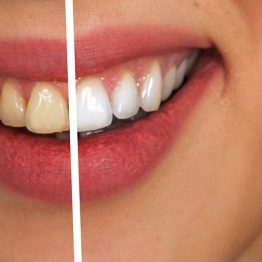 Teeth Whitening - Before and After Treatment