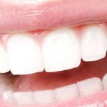 PureSmile - Teeth Whitening - white teeth smile
