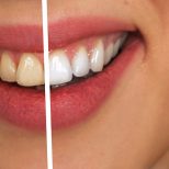 PureSmile - Teeth Whitening - Before and After Home Remedies
