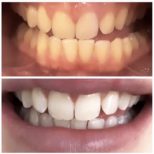 Before vs After teeth whitening