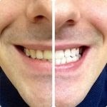 PureSmile Teeth Whitening Results