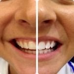 PureSmile Teeth Whitening
