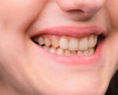what causes yellow teeth