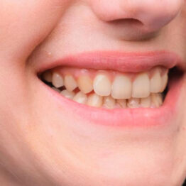 what causes yellow teeth