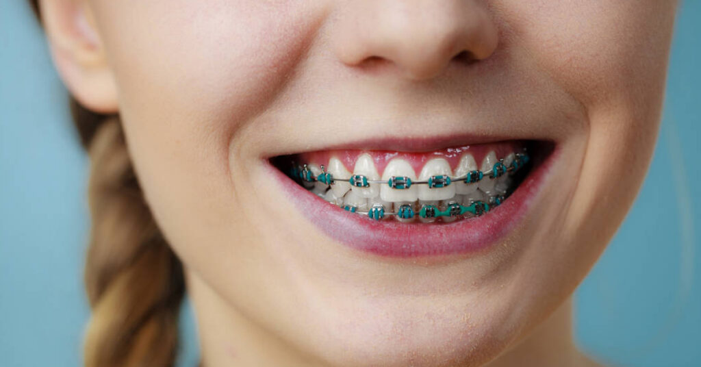 good braces colours